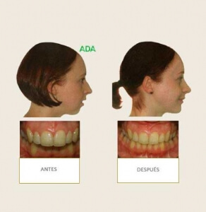 Clínica Dental Miguel Ángel - Ortodoncia Quirurgica