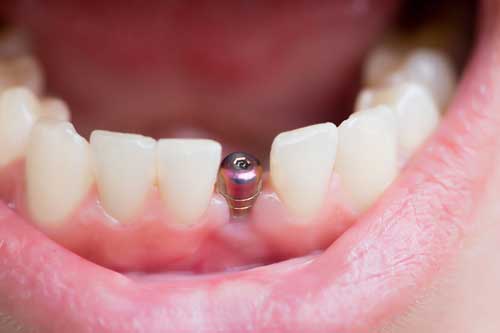 Implantes antes o después de ortodoncia