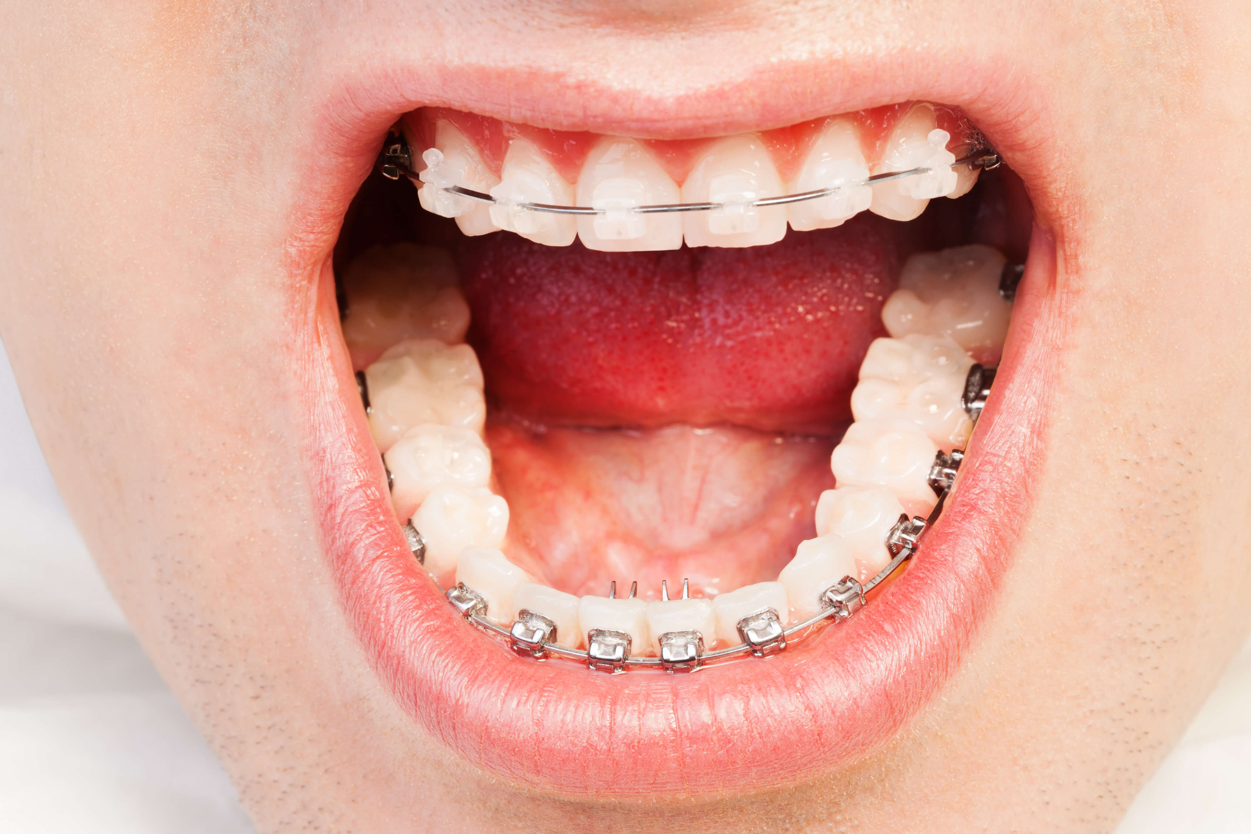 Brackets Autoligables En Palencia 
