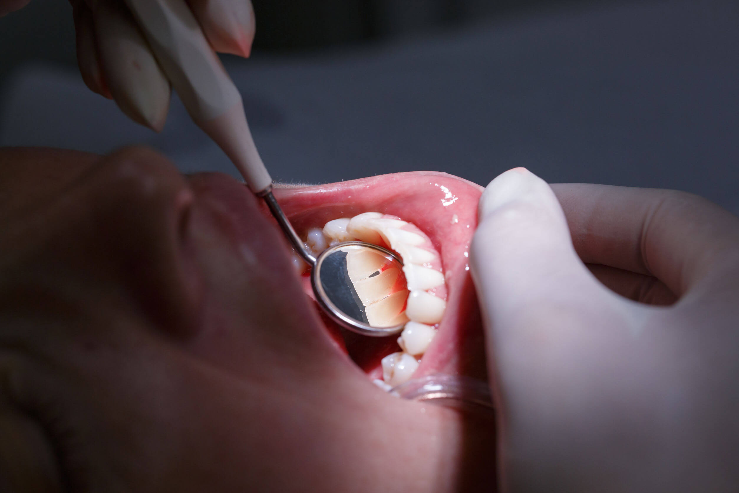 enfermedades periodontales, tratamientos
