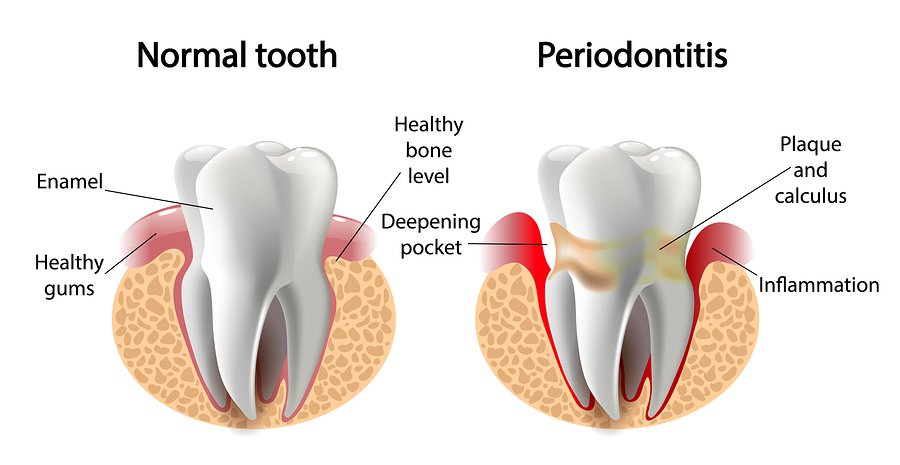 Gingivitis y periodontitis