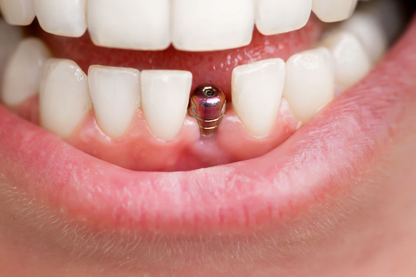 postoperatorio implantes dentales