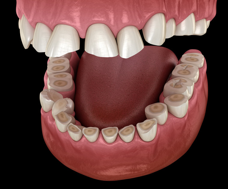 atrición dental