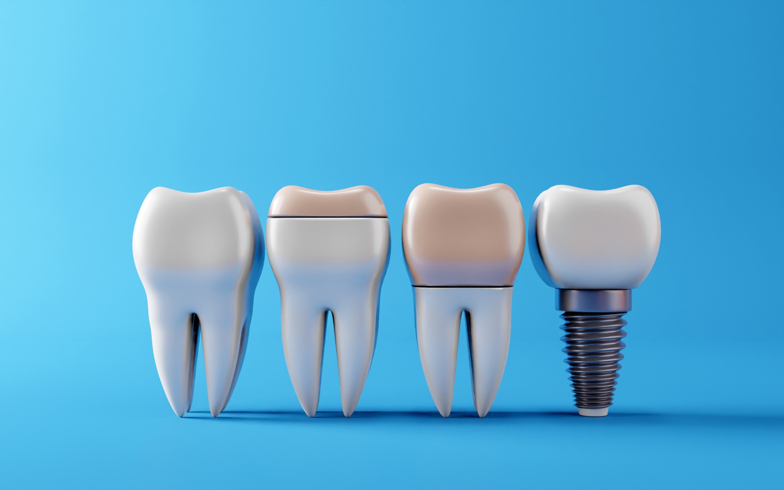 implantes dentales prolongar vida útil